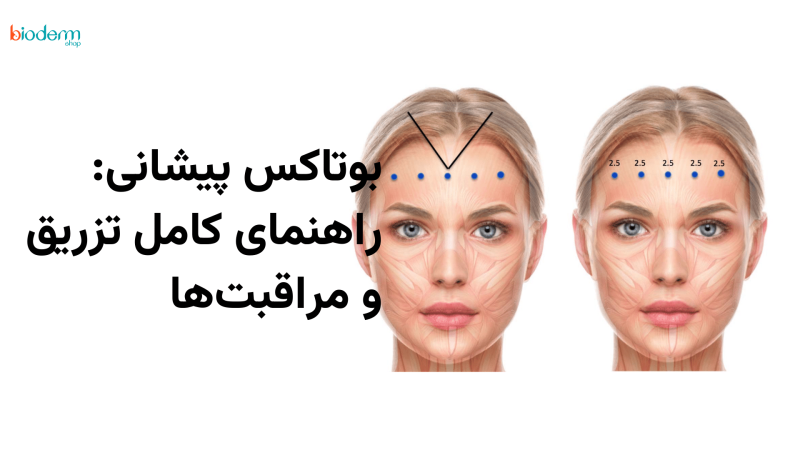 بوتاکس پیشانی؛ راهنمای کامل و مراقبتها