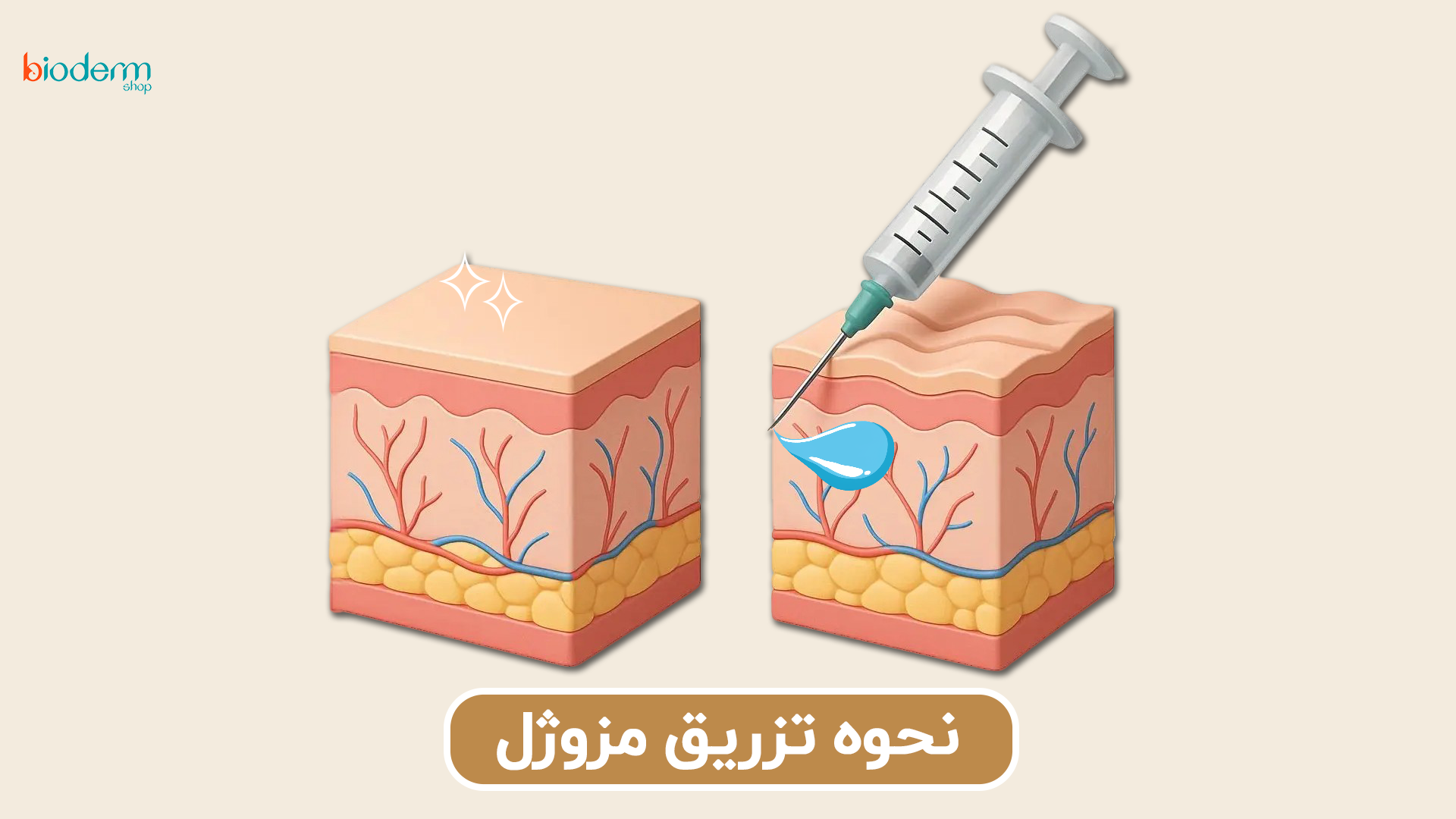 نحوه‌ تزریق مزوژل